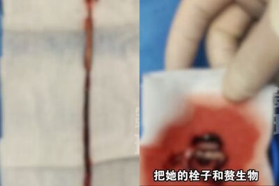 陸女高燒9天竟因「輸液管被血栓堵死」　醫嚇：感染炸彈險喪命​