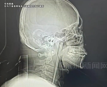 46歲男「誤吞12cm金屬筷」忍8年才取出　他坦言：當初怕開刀​