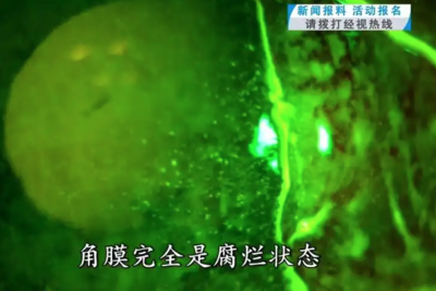 男子騎車遭「蚊子入眼」揉眼竟讓視力剩0.04　醫嘆：角膜全腐爛​