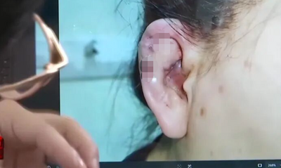 一針面癱！ 上海少女整形「精靈耳」栓塞終身殘疾​