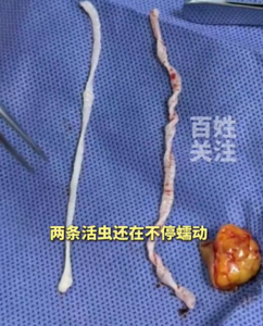 女子誤以為手臂長腫瘤「切開見2條10cm活蟲」 醫嚇喊:毛骨悚然